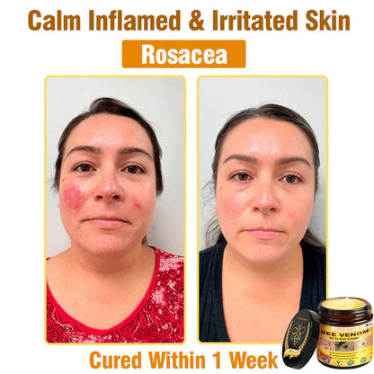 Bee Venom All-in-One Cream US Dermatologist Approved