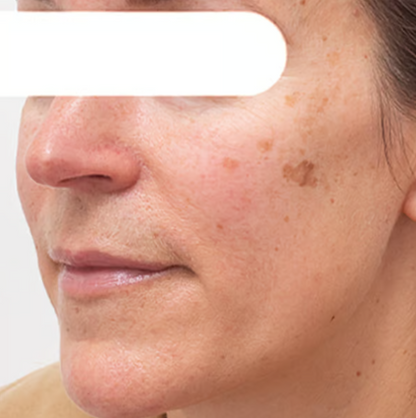 Herbal Spots Peel-Off Facial Mask